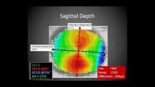 Corneal GP Lenses Video 1 [upl. by Ahsienet824]