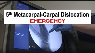 Fifth Metacarpal Dislocation and Reduction Emergency [upl. by Shorter]