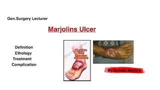 Marjolin ulcer surgery lecture surgery mbbs mbbsstudent neet2024 medical [upl. by Ellimak]