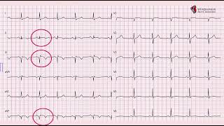 An ECG pattern in regression [upl. by Nahpets]