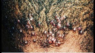 A Closer Look at Folliculitis And How To Treat ItThe Organic Way [upl. by Jagir]