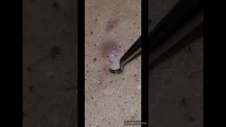 Close up Tweezing Removing multiple hairs from one follicle Satisfying tweezing [upl. by Cruz]