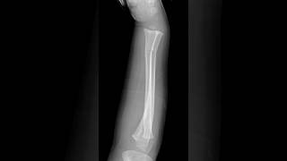 Greenstick fractures  radius and ulna shoets [upl. by Minna]