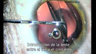 Lente intraocular para el tratamiento de la miopia hipermetropia y astigmatismo [upl. by Annaej523]