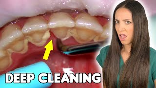 Deep Cleaning With HEAVY Tartar Build Up At The Dentist [upl. by Aehsal]