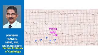 Findings and conclusion for this ECG [upl. by Kingsly597]