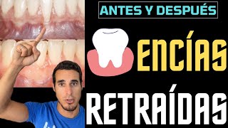 🦷 Transformación Dental Conoce el Asombroso Cambio de Nuestra Paciente saludbucal shorts [upl. by Elke]