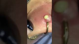 Extraction Satisfaisante 😌👌acne blackheads asmr [upl. by Rudelson136]