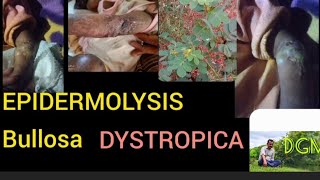 EPIDERMOLYSIS BULLOSA DYSTROPICAAYURVEDA [upl. by Arva570]