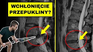 Przepuklina  czy może się cofnąć rwa kulszowa dyskopatia kręgosłup lędźwiowy [upl. by Eneg]