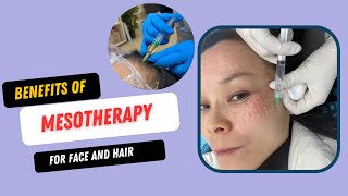 Mesotherapy  Notice facial wrinkles and hair loss when you are 40 [upl. by Leibarg]