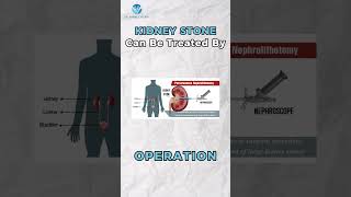 How To Treat Stone In Gallbladder  doctor healthcare shorts youtubeshorts gallbladderhealth [upl. by Nay317]