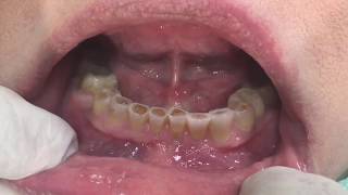 Houston Cosmetic Dentist Worn down short teeth Now there is a solution [upl. by Lester205]