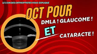 Pourquoi faire un OCT  pour le Glaucome la DMLA la Cataracte Ophtalmologie Orthoptie [upl. by Radbun]