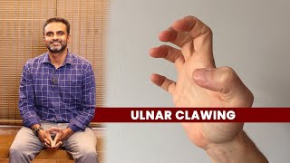 Ulnar Clawing  Dr Sree Charan [upl. by Aielam]