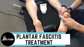 Plantar Fasciitis Treatment San Diego Graston Chiropractic [upl. by Saudra]