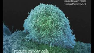 What Does Cancer Look Like  Cancer Research UK [upl. by Davenport161]