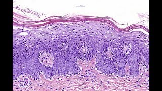 Acrodermatitis enteropathica Phillip H McKee Antonina Kalmykova  CSD Health Care [upl. by Enneirda]