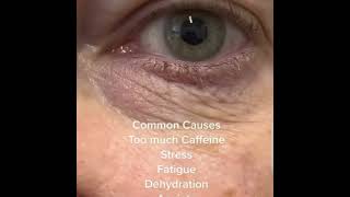 Blepharospasm shortvideoopthalmiceyesoptometristfactsstresscaffiene [upl. by Elletnahc477]