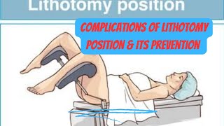 complications of lithotomy position amp its prevention obgyneLearning [upl. by Lindholm]