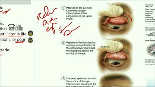 Ophthalmology Trachoma شرح بالعربى الرمد الحُبيبي التراخوما [upl. by Lunetta799]