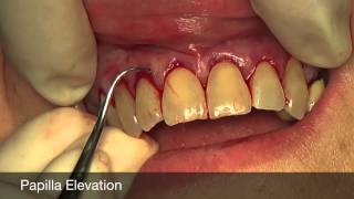 Alloderm  Acellular Dermal Matrix for Treatment of Dental Recession [upl. by Deys833]