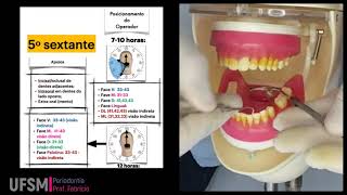 Sessão supragengival  Quinto sextante [upl. by Warren328]