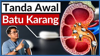 Batu Karang Buah Pinggang  5 Tanda Awal Wajib Tahu  Doctor Sani [upl. by Dianuj471]