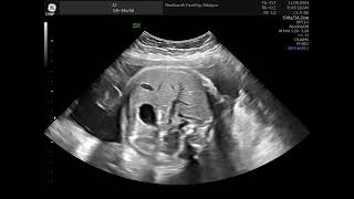 Fetal Breathing Respiratory movements Biophysical profile [upl. by Ariday]