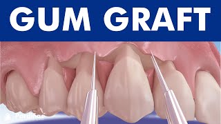 Gum graft  Coronally advanced flap  Receding gums treatment © [upl. by Aliuqa673]