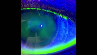 Conjunctive Staining After Scleral Lens Removal [upl. by Neddy]