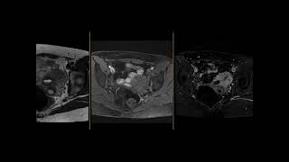 Cystic adenomyoma [upl. by Darraj]