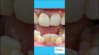 Crooked Teeth 5 Common Causes and How to Avoid them [upl. by Steele]