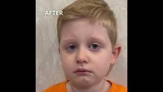 NYSTAGMUS TREATMENT SUCCESSFUL CASE CRYSTAL VISION CLINIC [upl. by Adnilab550]