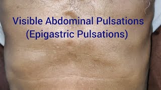 Clinical Examination Visible Epigastric Pulsations [upl. by Ellainad]