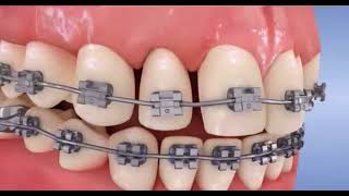 Orthodontie  Comment resserrer ses dents avec des bagues [upl. by Aleuname]