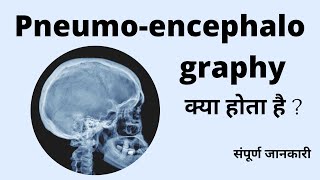 Pneumoencephalography Radiological procedure Air study PEG Study क्या होता है  संपूर्ण जानकारी [upl. by Euqnomod]