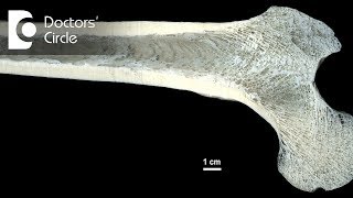 Osteomyelitis  Meaning Causes amp its Treatment  Dr Gururaj S Puranik [upl. by Lewiss549]