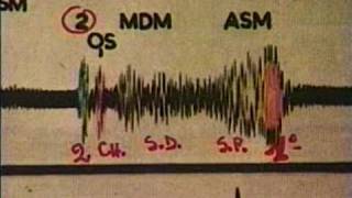 Bases de la Auscultacion Cardiaca II [upl. by Porcia]