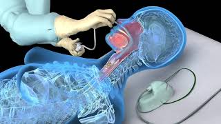 Nasotracheal suctioning NTS  3D animation [upl. by Annaiuq]