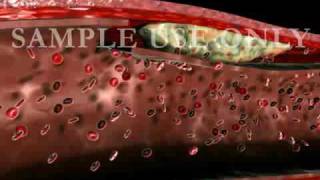 Artery Dissection Medical Animation [upl. by Liatris757]