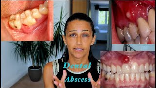 How to treat a Dental Abscess Different Natural Mouthrinses and their uses [upl. by Allimrac]