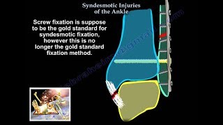 Syndesmotic Injuries Of The Ankle  Everything You Need To Know  Dr Nabil Ebraheim [upl. by Mandy929]