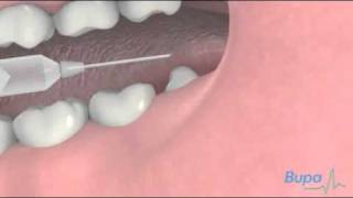 How a wisdom tooth is removed [upl. by Lucio]