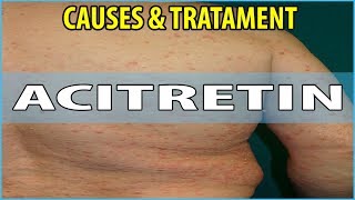 What is Acitretin Causes Symptoms and Treatments [upl. by Yor]