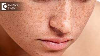 How to get rid of freckles on face  Dr Swetha Sunny Paul [upl. by Ackerley685]