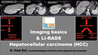 Imaging for Liver Cancer amp LIRADS Hepatocellular carcinoma radiology masterclass  Edusurg clinics [upl. by Asil]