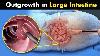 Colon Polypectomy  Removal Of Polyps From Large intestine UrduHindi [upl. by Ibrek352]