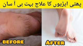 Crack Heel RemedyRemove Dry And Dead Skin From Hand amp Feet  Best FormulaHoori hacks and Tips [upl. by Zitah]