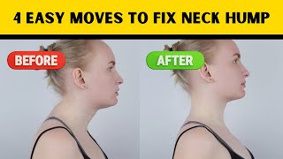 Say Goodbye to Dowagers Hump 4 Quick Yoga Moves for Fixing Neck Hump [upl. by Assirrac]